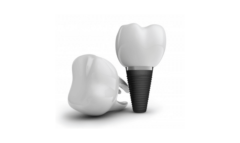 5 Amazing Benefits of Dental Implants Over Other Dental Restorations