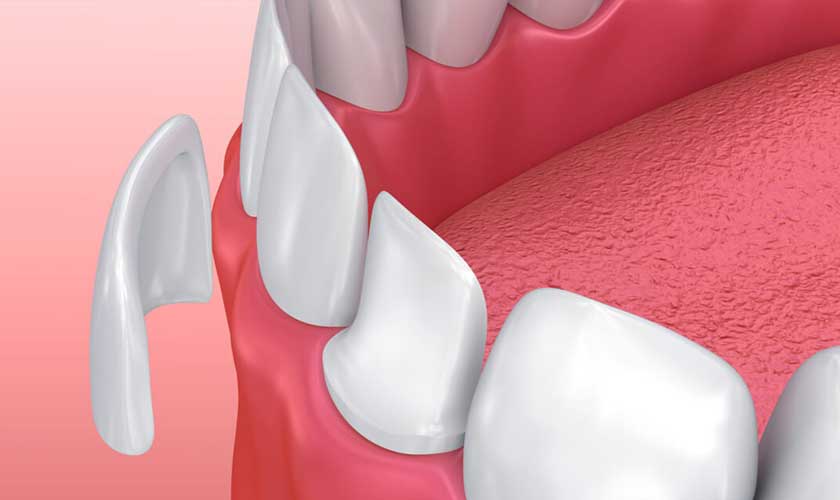 Dental Veneers – What You Need to Know