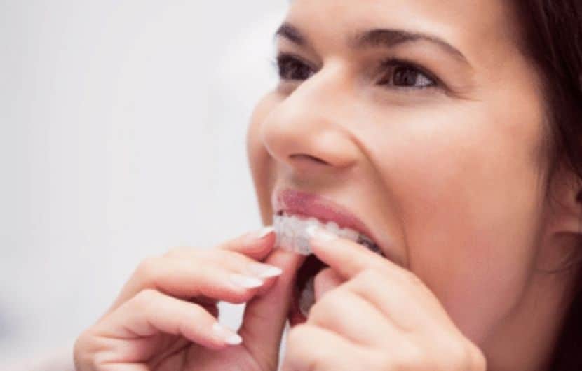How To Financially Plan Your Invisalign Treatment?