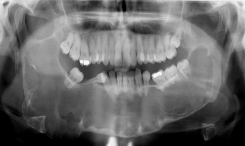 Ankylosed Teeth | Belmont Dentistry – Dentist Scottsdale AZ
