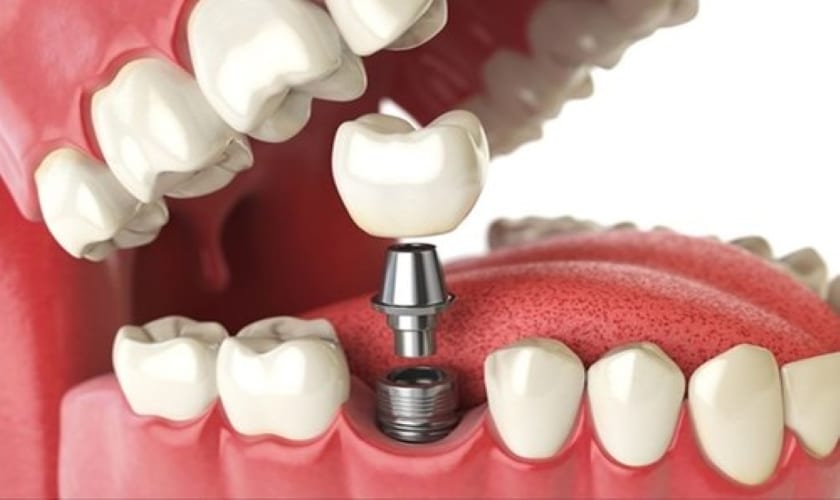 What Is The Average Cost of All-On-4  Dental Implants?