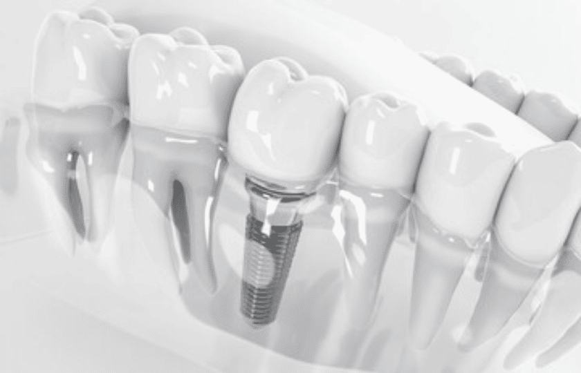 Some Interesting Facts About Dental Implants