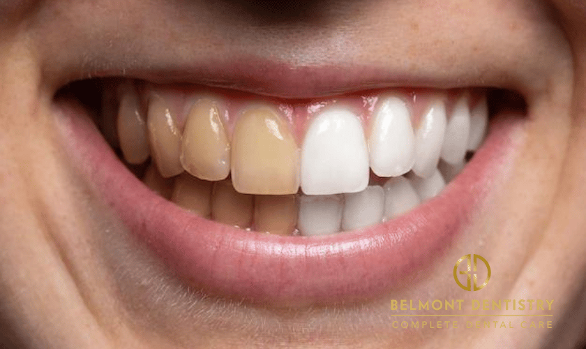 How to avoid staining your teeth?