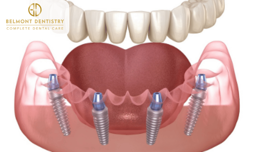 What Are the Various Benefits of All-On-4 Implants?