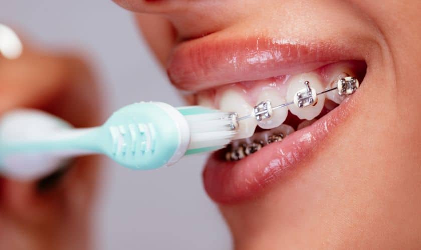 When Having Braces, Is It Possible To Whiten Your Teeth?