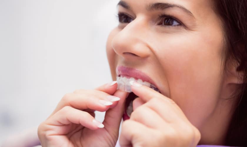 The Importance of Wearing Retainers After Invisalign
