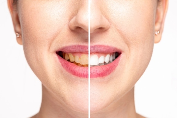 teeth stain removal and whitening solutions