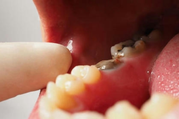 what is a root cavity and how can you prevent it