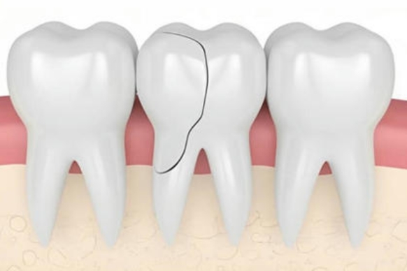 what to do if you have a cracked molar