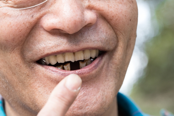 dental options for replacing missing teeth