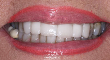 after dental implants in scottsdale az at belmont dentistry