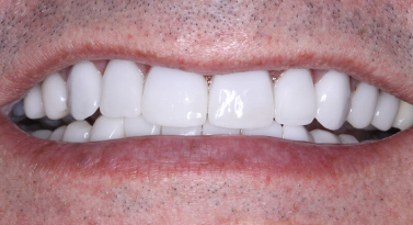 after in office teeth whitening in scottsdale az at belmont dentistry