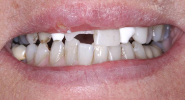 before dental implants in scottsdale az at belmont dentistry