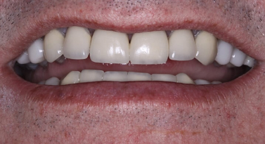 before in office teeth whitening in scottsdale az at belmont dentistry
