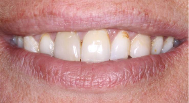 before teeth whitening in scottsdale az at belmont dentistry