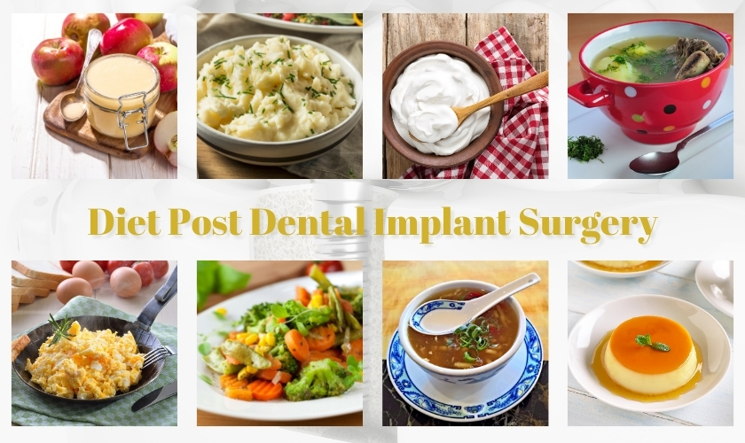 post dental implant surgery foods