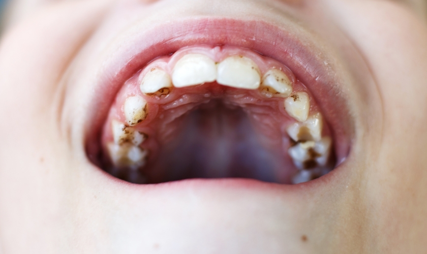 causes of grey stains on teeth