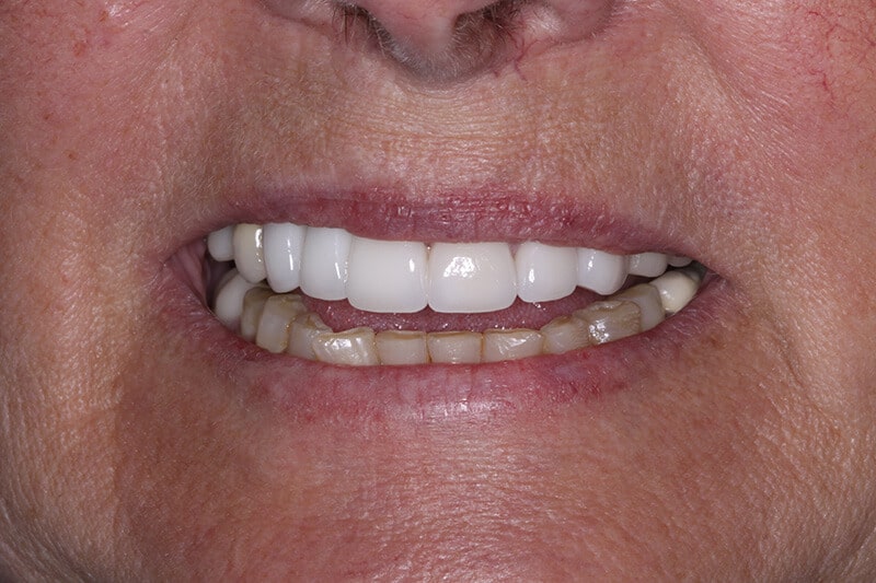after all on 4 dental implants