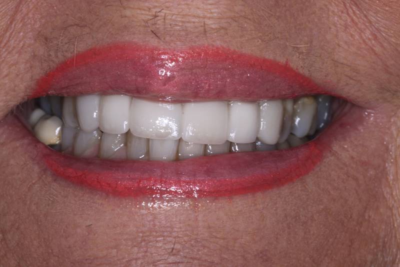 after dental implants
