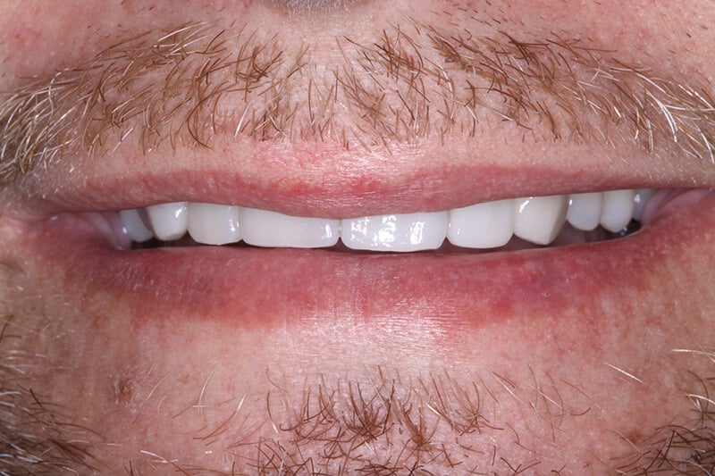 after dental veneers