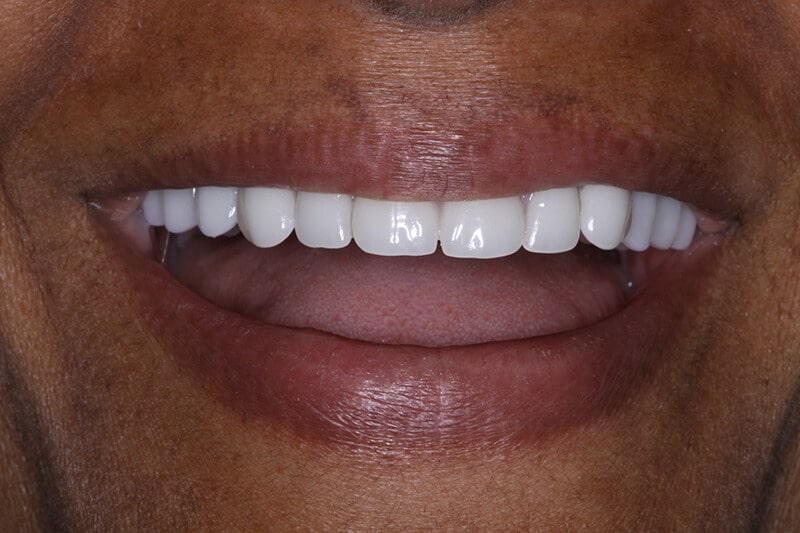 after dental veneers