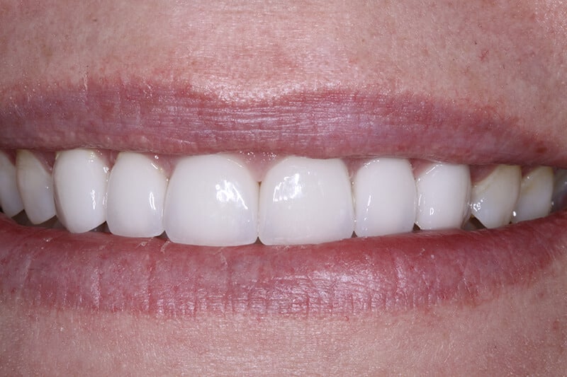 after dental veneers