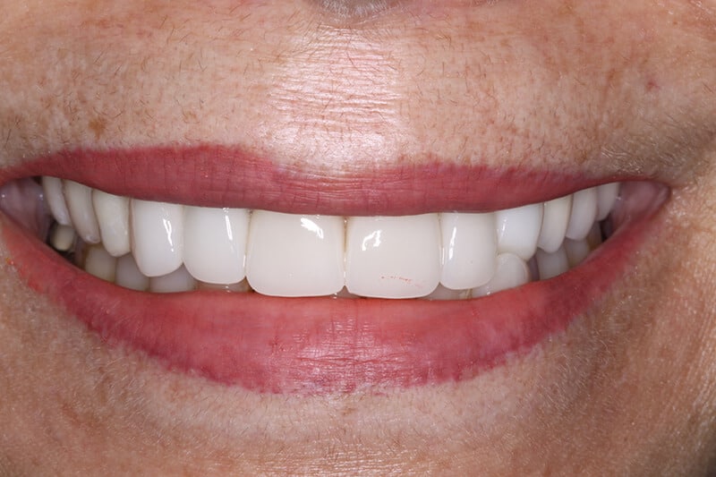 after dental veneers