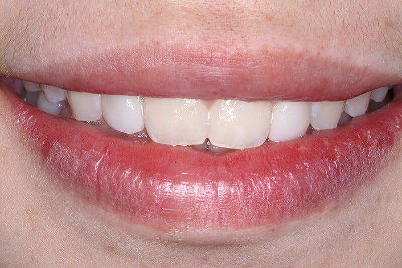 after dental veneers