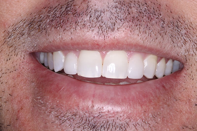after dental veneers