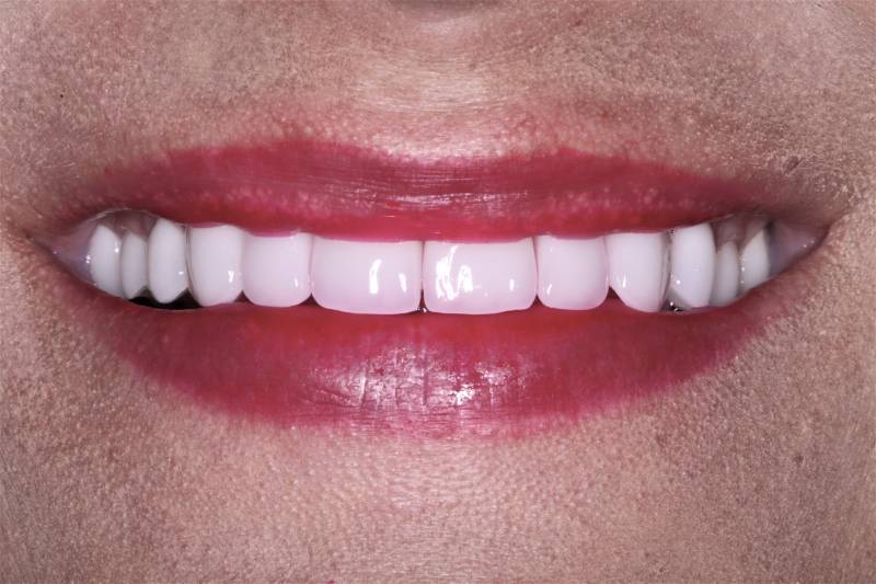 after dental veneers
