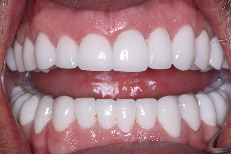 after full mouth reconstruction