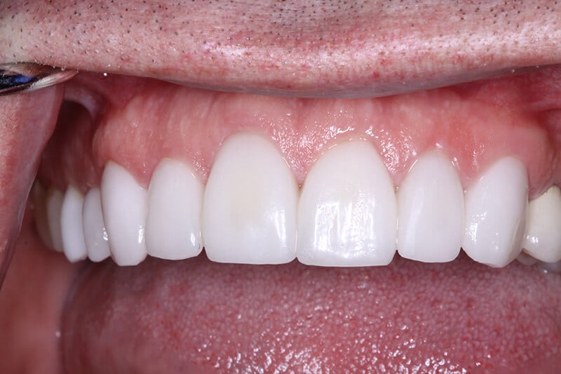 after in office teeth whitening