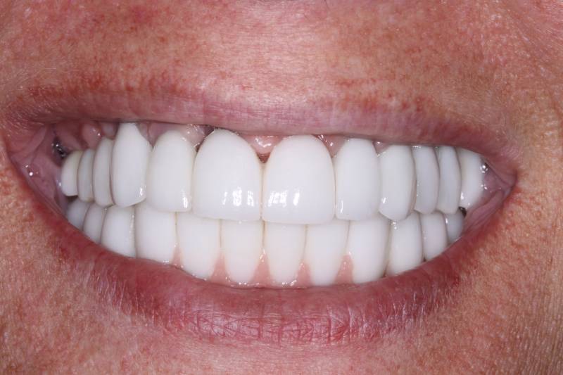 after in office teeth whitening at belmont dentistry