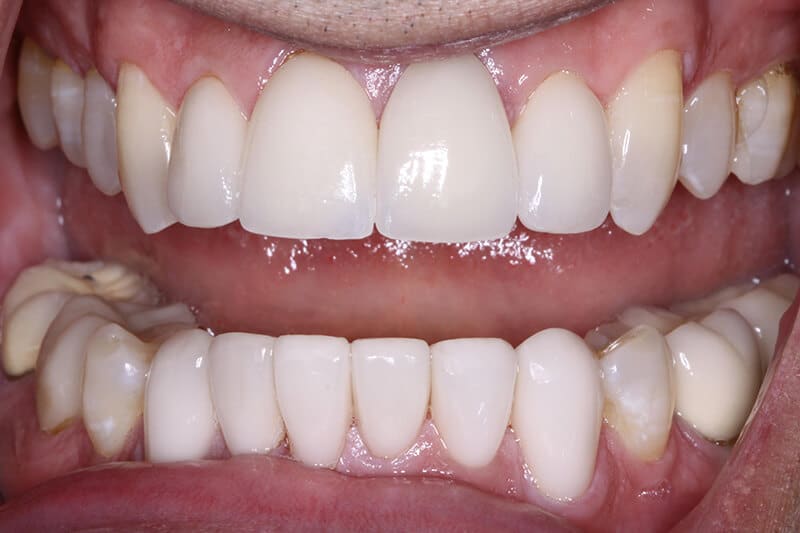 after invisalign treatment