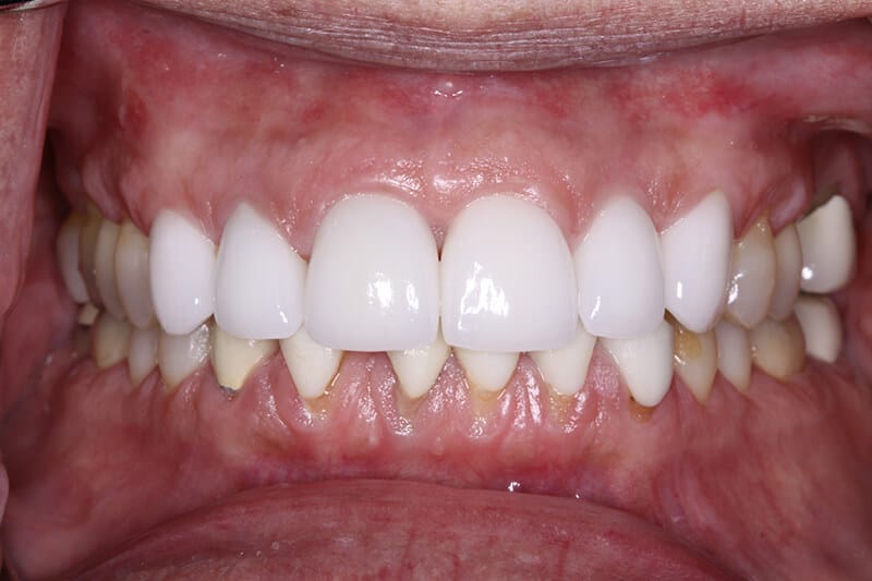 after invisalign treatment