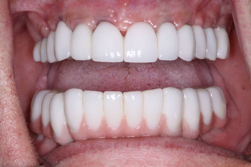 after invisalign treatment