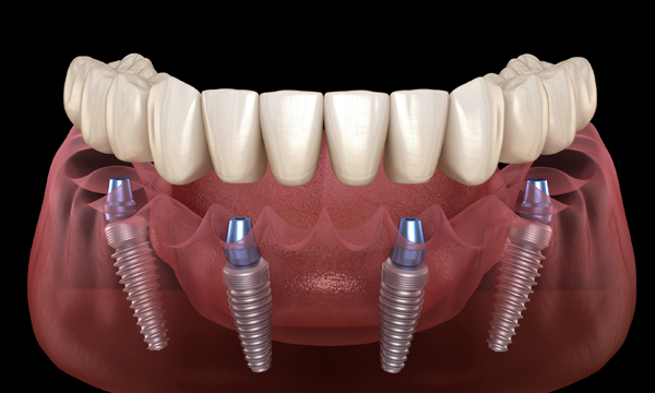 all on 4 dental implant in scottsdale az at belmont dentistry