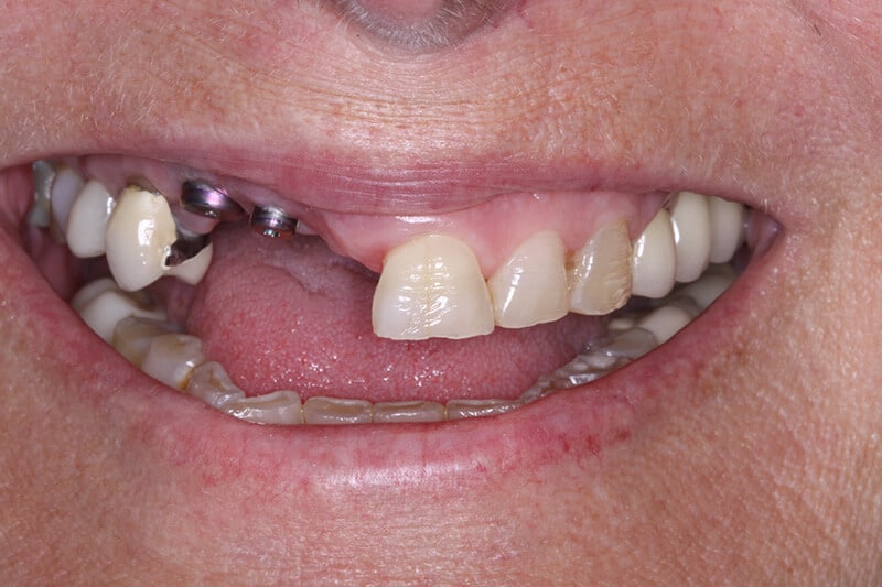 before all on 4 dental implants