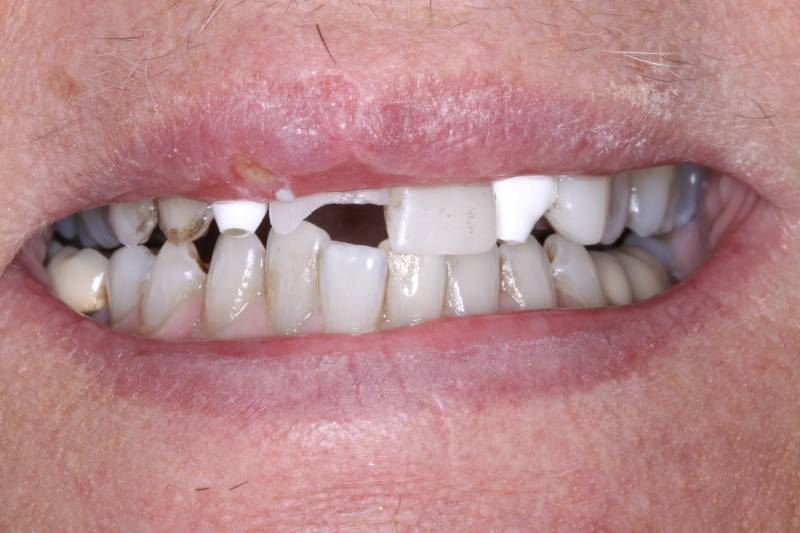 before dental implants