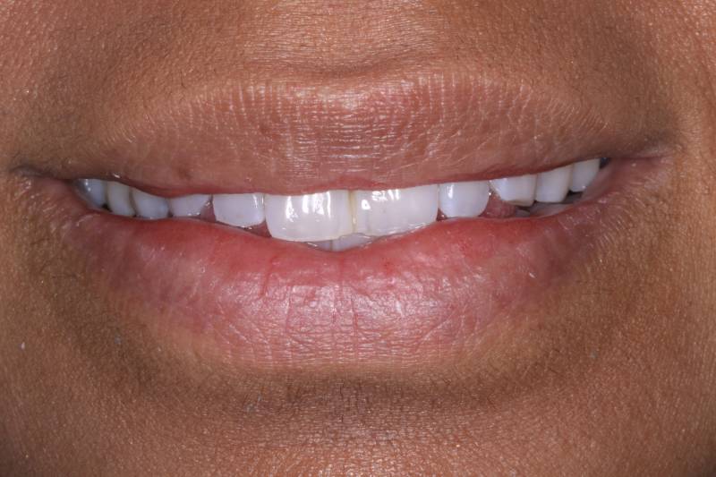 before dental veneers