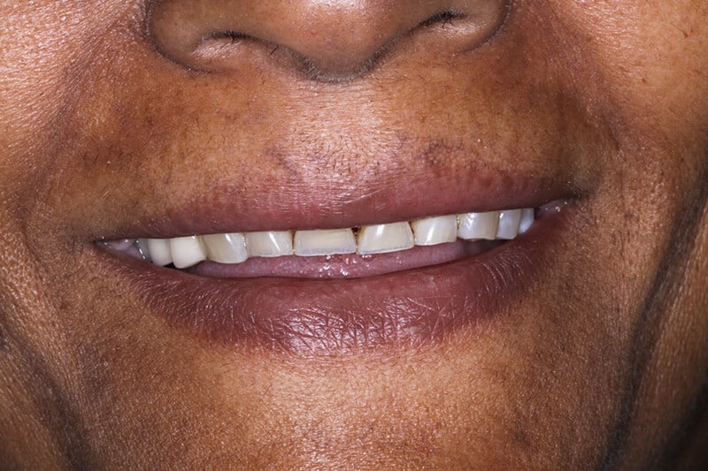 before dental veneers