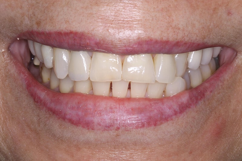 before dental veneers