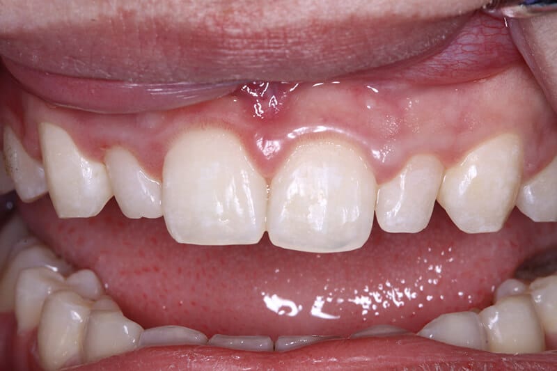 before dental veneers