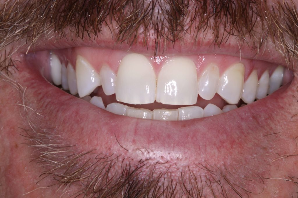 before dental veneers