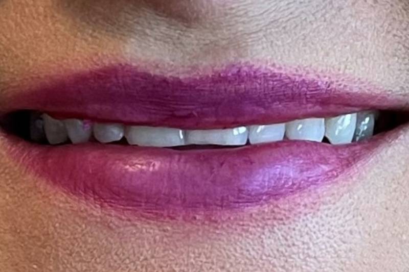 before dental veneers