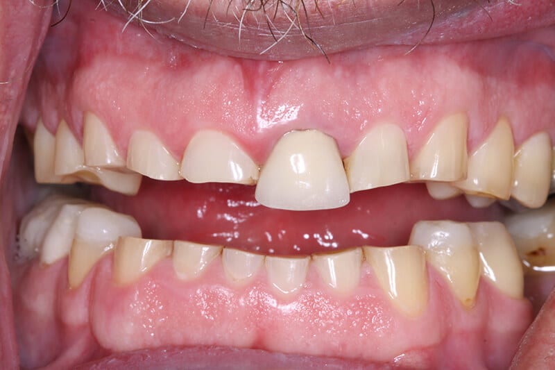 before full mouth reconstruction