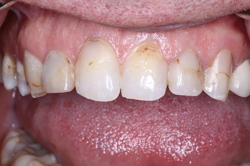 before in office teeth whitening