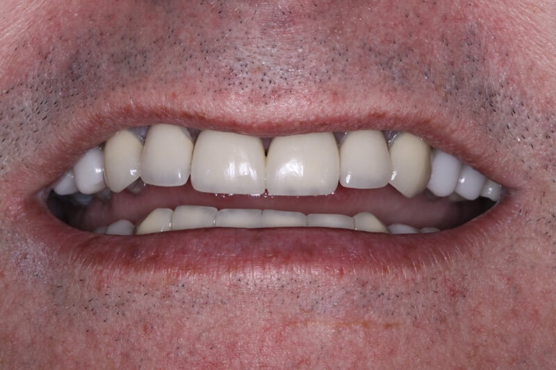 before in office teeth whitening