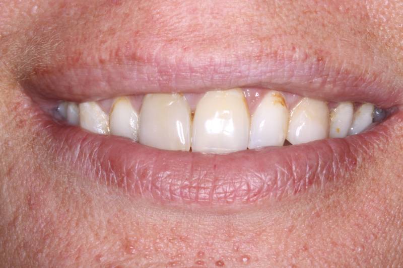 before in office teeth whitening