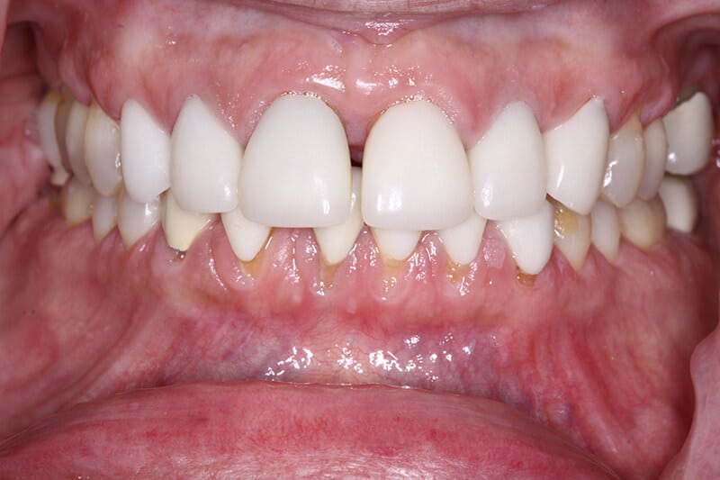 before invisalign treatment